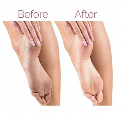 Rechargeable Electric Foot Callus Remover – Pedicure Foot File